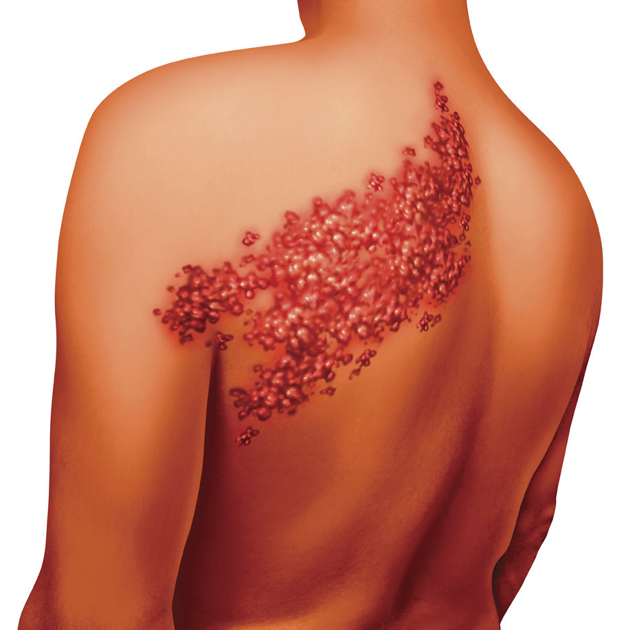 How to protect yourself against the shingles virus