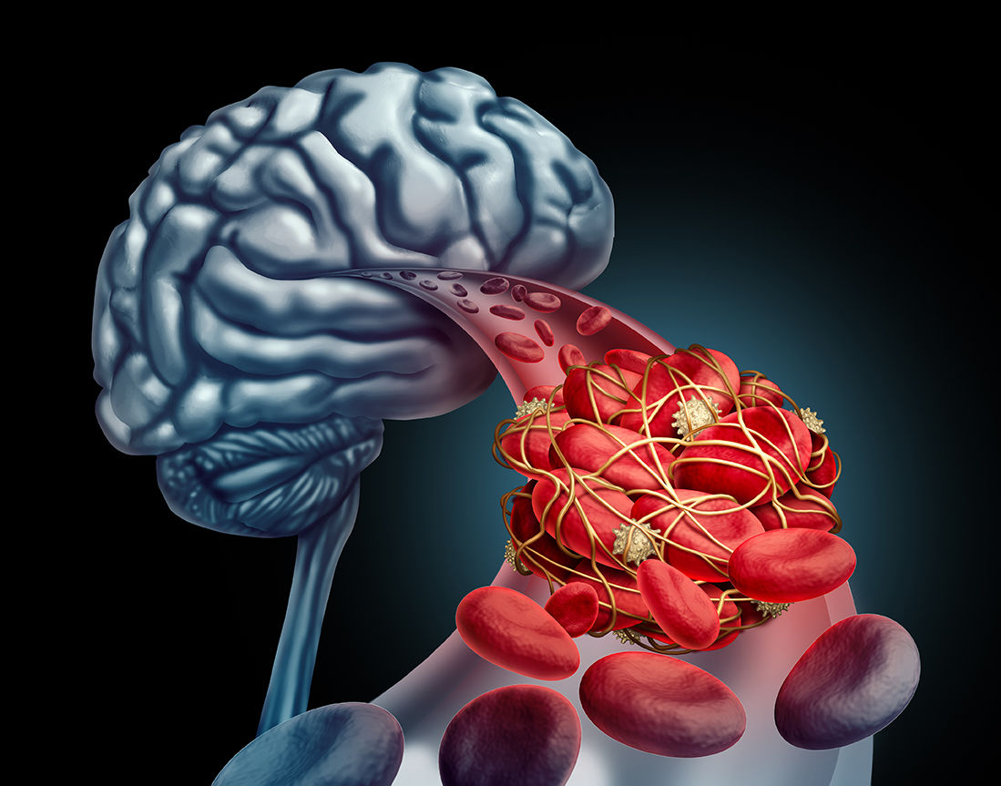 Know the signs and symptoms of stroke — the No. 5 cause of death in the United States